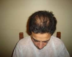 Slider image (5) Vita Hair | Clinica Capilar